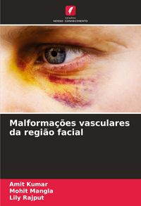 Produktbild: Malforma&ccedil;&otilde;es vasculares da regi&atilde;o facial