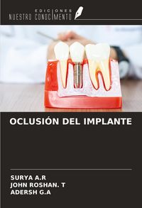 Produktbild: Oclusi&oacute;n Del Implante