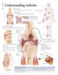 Produktbild: Understanding Arthritis Chart
