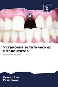 Produktbild: Ustanowka &auml;steticheskih implantatow