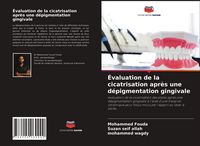 Produktbild: &Eacute;valuation de la cicatrisation apr&egrave;s une d&eacute;pigmentation gingivale