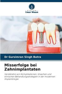 Produktbild: Misserfolge bei Zahnimplantaten