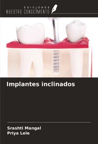Produktbild: Implantes inclinados