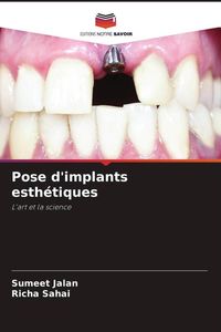 Produktbild: Pose d'implants esth&eacute;tiques
