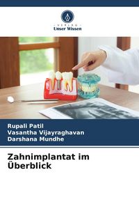 Produktbild: Zahnimplantat im &Uuml;berblick