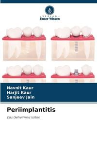 Produktbild: Periimplantitis