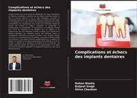 Produktbild: Complications et &eacute;checs des implants dentaires