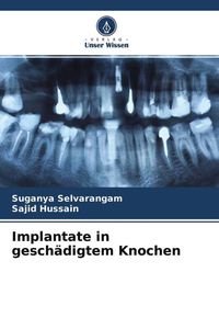 Produktbild: Implantate in gesch&auml;digtem Knochen