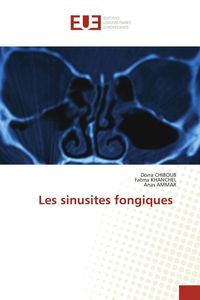 Produktbild: Les sinusites fongiques