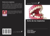 Produktbild: &Eacute;xito de los implantes