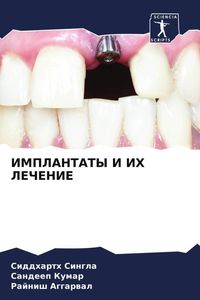 Produktbild: Implantaty I Ih Lechenie