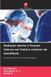 Produktbild: Redu&ccedil;&atilde;o aberta e fixa&ccedil;&atilde;o interna em fratura anterior de mand&iacute;bula