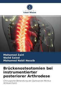Produktbild: Br&uuml;ckenosteotomien bei instrumentierter posteriorer Arthrodese