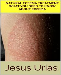 Produktbild: Natural Eczema Treatment