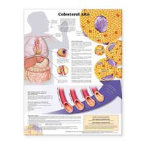 Produktbild: High Cholesterol Anatomical Chart in Spanish (Colesterol Alto)