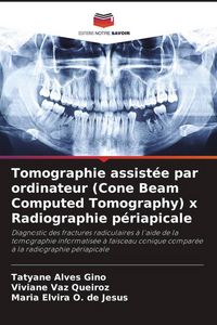 Produktbild: Tomographie assist&eacute;e par ordinateur (Cone Beam Computed Tomography) x Radiographie p&eacute;riapicale