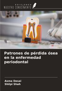 Produktbild: Patrones de p&eacute;rdida &oacute;sea en la enfermedad periodontal