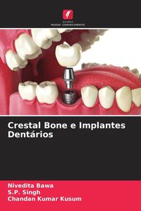 Produktbild: Crestal Bone e Implantes Dent&aacute;rios