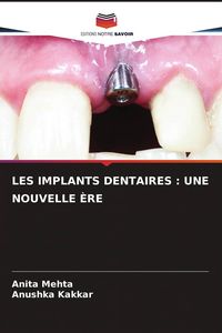 Produktbild: Les Implants Dentaires : Une Nouvelle &Egrave;re