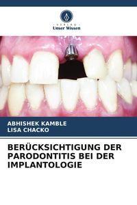 Produktbild: Ber&uuml;cksichtigung der Parodontitis bei der Implantologie