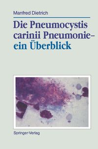 Produktbild: Die Pneumocystis carinii Pneumonie- ein &Uuml;berblick