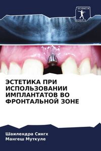 Produktbild: Jestetika Pri Ispol'zovanii Implantatov Vo Frontal'noj Zone