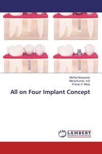 Produktbild: All on Four Implant Concept