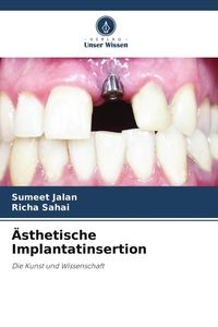 Produktbild: &Auml;sthetische Implantatinsertion