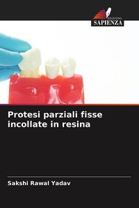 Produktbild: Protesi parziali fisse incollate in resina