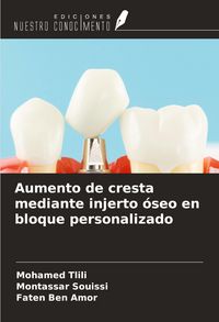 Produktbild: Aumento de cresta mediante injerto &oacute;seo en bloque personalizado