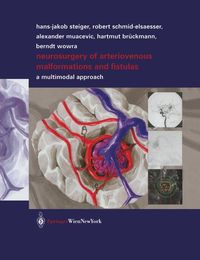Produktbild: Neurosurgery of Arteriovenous Malformations and Fistulas