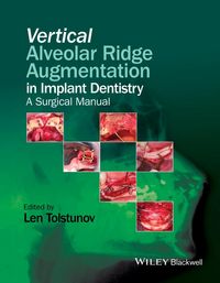 Produktbild: Vertical Alveolar Ridge Augmentation in Implant Dentistry