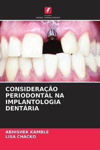 Produktbild: Considera&ccedil;&atilde;o Periodontal Na Implantologia Dent&aacute;ria