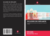 Produktbild: Oclus&atilde;o Do Implante