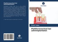 Produktbild: Plattformwechsel bei zahnimplantaten