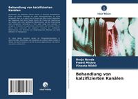 Produktbild: Behandlung von kalzifizierten Kan&auml;len