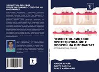 Produktbild: Cheljustno-Licevoe Protezirovanie S Oporoj Na Implantat