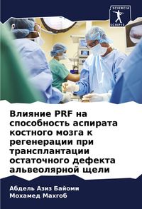 Produktbild: Vliqnie PRF na sposobnost' aspirata kostnogo mozga k regeneracii pri transplantacii ostatochnogo defekta al'weolqrnoj scheli