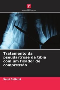 Produktbild: Tratamento da pseudartrose da t&iacute;bia com um fixador de compress&atilde;o