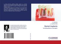 Produktbild: Dental Implants