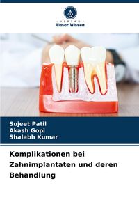 Produktbild: Komplikationen bei Zahnimplantaten und deren Behandlung