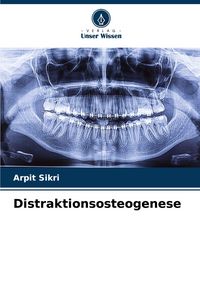 Produktbild: Distraktionsosteogenese
