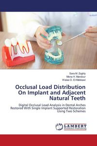 Produktbild: Occlusal Load Distribution On Implant and Adjacent Natural Teeth
