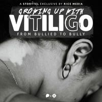 Produktbild: Growing Up With Vitiligo, I Was Bullied&mdash;Until I Became A Bully