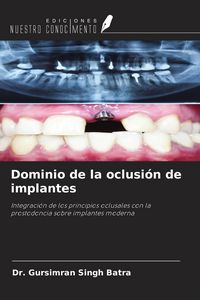 Produktbild: Dominio de la oclusi&oacute;n de implantes