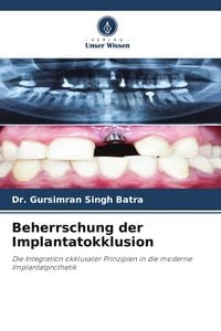 Produktbild: Beherrschung der Implantatokklusion