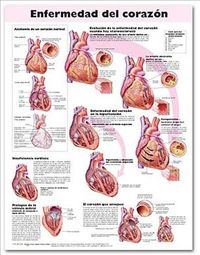 Produktbild: Heart Disease Anatomical Chart in Spanish (Enfermedad del Corazon)