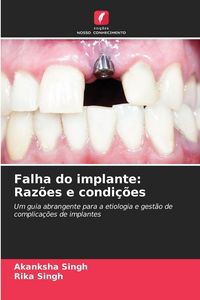 Produktbild: Falha do implante: Raz&otilde;es e condi&ccedil;&otilde;es