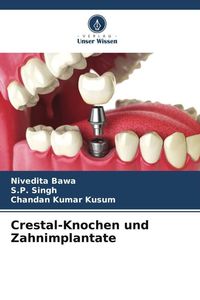 Produktbild: Crestal-Knochen und Zahnimplantate