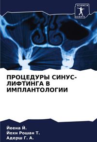 Produktbild: Procedury Sinus-Liftinga V Implantologii